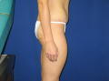 Tummy Tuck after 143464