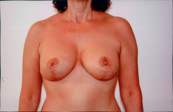 Breast Lift after 218954