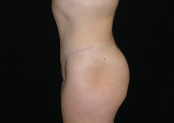 Abdominoplasty 476707