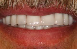 Dental Implants after 510550