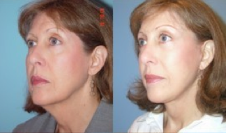 Lower Facelift, Brow Re-positioning, Upper Eyelid Surgery after 366963