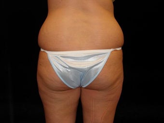 Brazilian Butt Lift before 227257