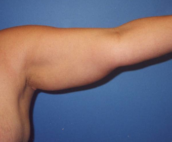 Arm Lift before 230659