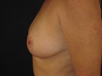 Breast Reduction after 291350