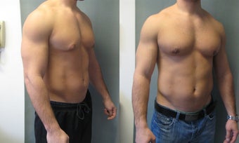 Gynecomastia New York 349231