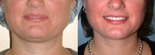 Liposuction (chin and jaw line) before 96475