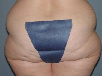 Liposuction hips, waist, upper and lower abdomen, lateral thighs 581418