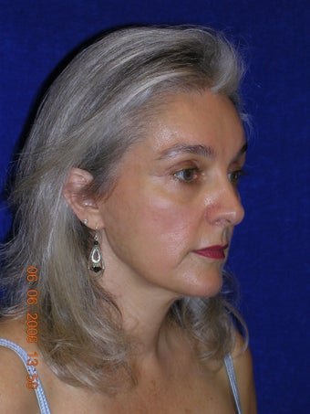 Facelift, Eyelid lift after 466264