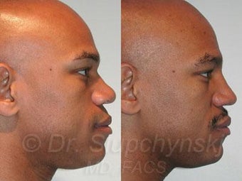African American Rhinoplasty after 374019