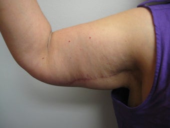 Arm Lift after 389008