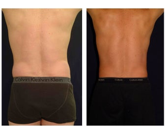 Liposuction before 286843