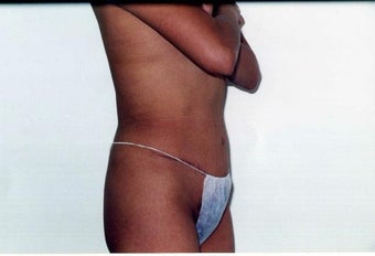 Tummy Tuck after 215127