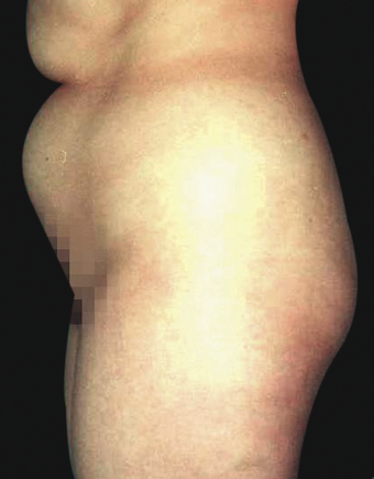 Tummy Liposuction before 229684