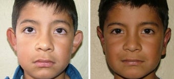 Otoplasty ear augmentation before 346236