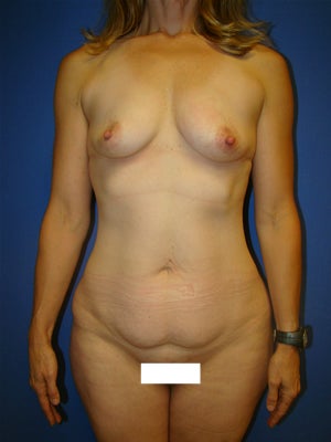 Extended Tummy Tuck and Breast Implants before 134340
