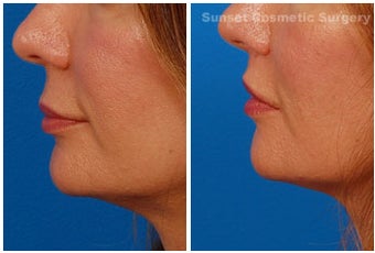 Lip lift 355955