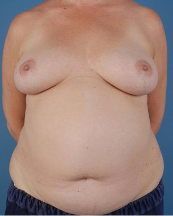 Breast Reconstruction before 509615