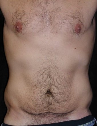 Male tummy Tuck, Flank Liposuction, Male Breast Reduction before 578158