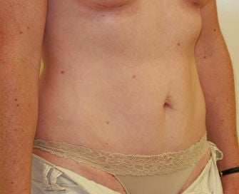 Mini-abdominoplasty 493674