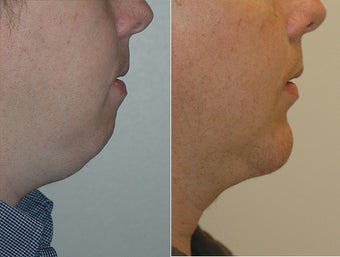 Chin Augmentation before 472206