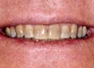 Kor Deep Bleaching Tooth Whitening System before 257924