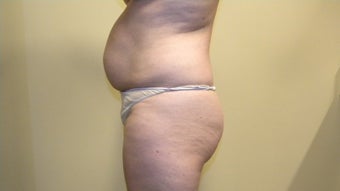 Abdominoplasty (Tummy-tuck) 402723