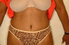 Abdominoplasty after 87345