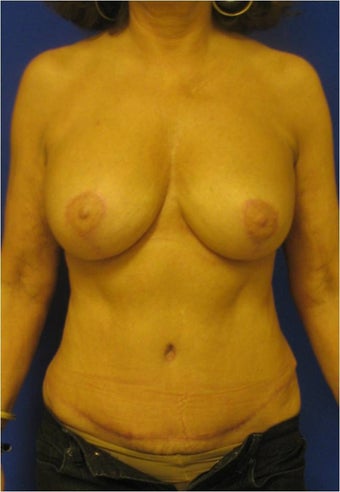 Breast Lift and Abdominoplasty after 302927