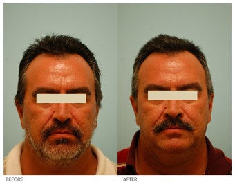 Acne Scarring Correction before 136797