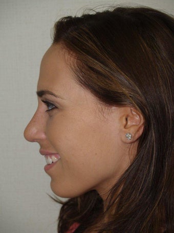 Rhinoplasty after 229058