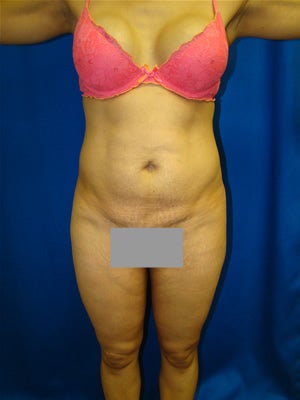 Tummy Tuck Surgery (Abdominoplasty) before 105128