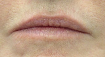 Juvederm and Botox to lips before 240185