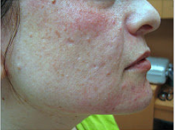 Fractional laser used to treat acne scars before 460041