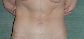 Lower body lift for massive weight loss after 117047