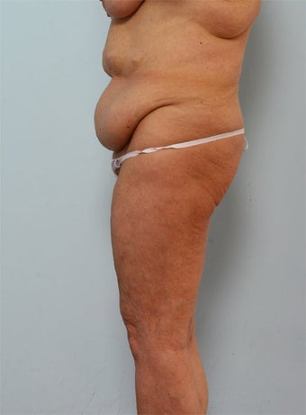 Body Lift before 260132