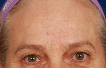 Mole Removal before 258477