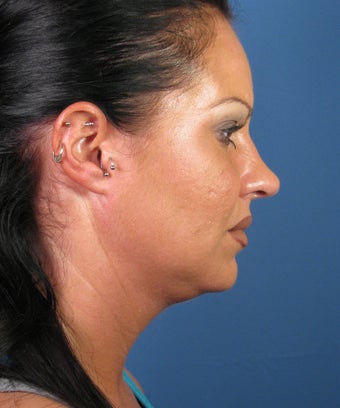 Liposuction 446439