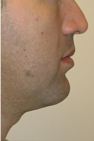 Chin augmentation, neck liposuction and neck muscle tightening. after 277315