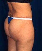 Brazilian Butt Lift after 635100