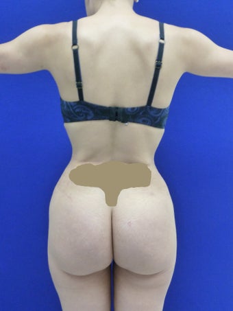 Butt Augmentation after 489491