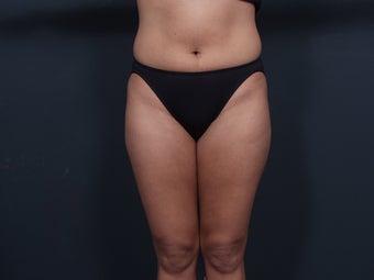 Liposuction before 462488