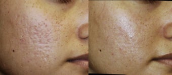 Acne scar after 182792
