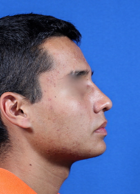 nasal airway surgery with cosmetic improvement 478799