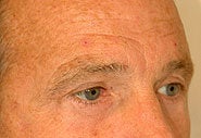 Eyelid Surgery and Brow Lift after 87330