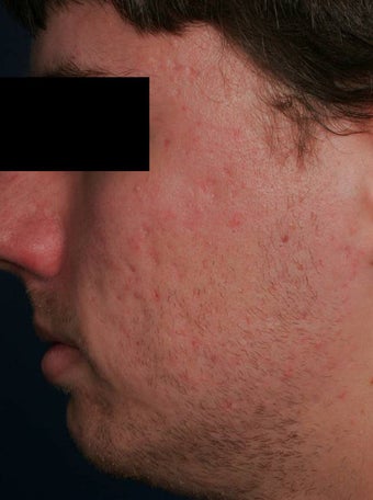 Fraxel - acne scars before 136199