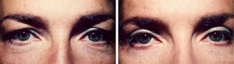 Blepharoplasty-Mid-Face before 285044