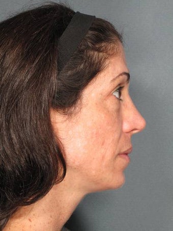 Premier Perfecting Peel after 429579