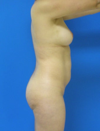 Brazilian Butt Lift 367398