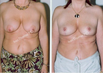 Mastopexy-Breast Lift before 243723