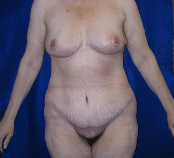 Body Lift and Breast Lift after 400450